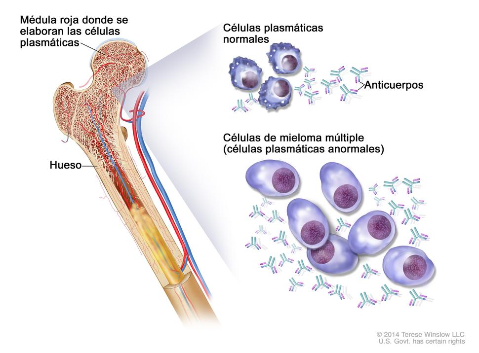 en la ilustración, se muestran células plasmáticas normales, células de mieloma múltiple (células plasmáticas anormales) y anticuerpos. También se muestra la médula roja en el hueso, en donde se elaboran las células plasmáticas.