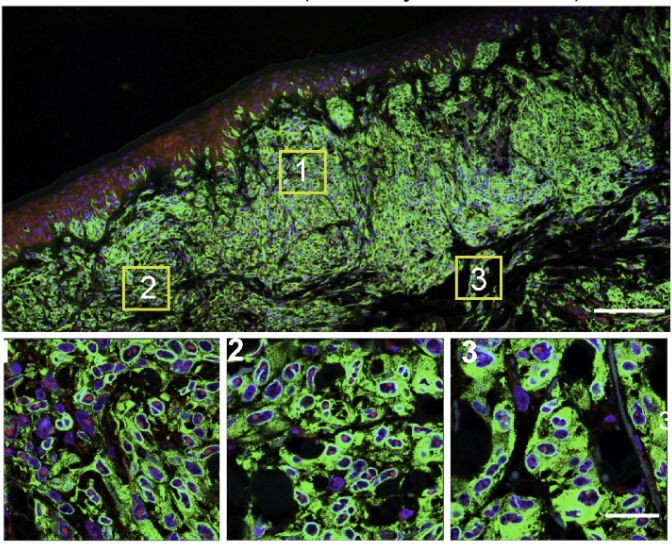 A microscopic image of melanoma cells, highlighting the androgen receptor in cell nuclei