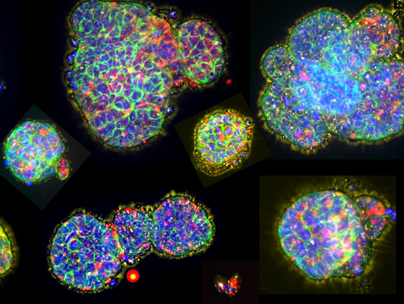 Immunofluorescence images of micro-organospheres created from a human lung tumor.