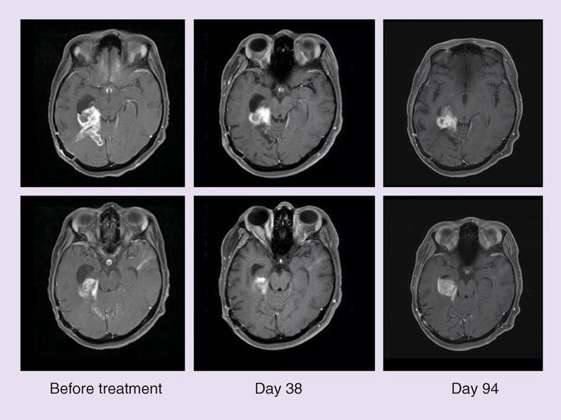 MRI scans of BRAF-positive brain tumors after dabrafenib and trametinib treatment.