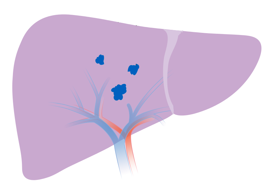 Illustración de un hígado con 3 tumores, cada tumor mide menos de 5 cm.