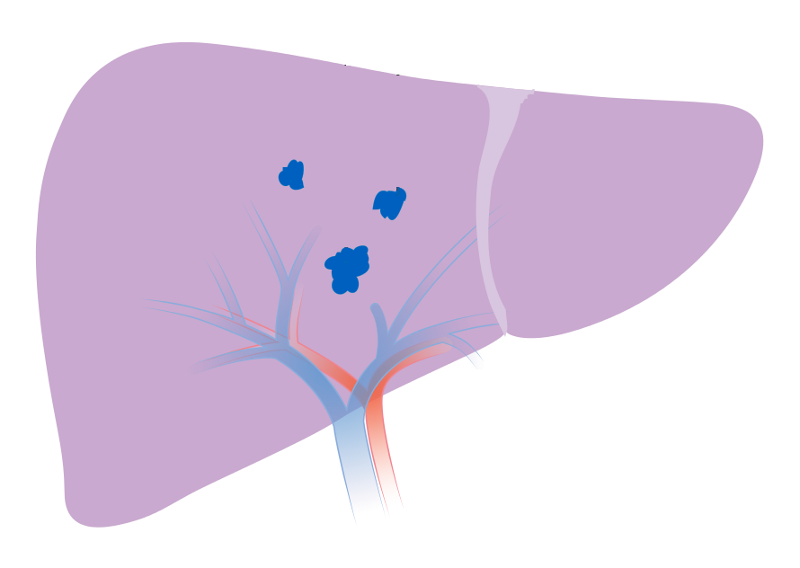 An illustration of a liver with 3 tumors, each less than 5 cm in size.