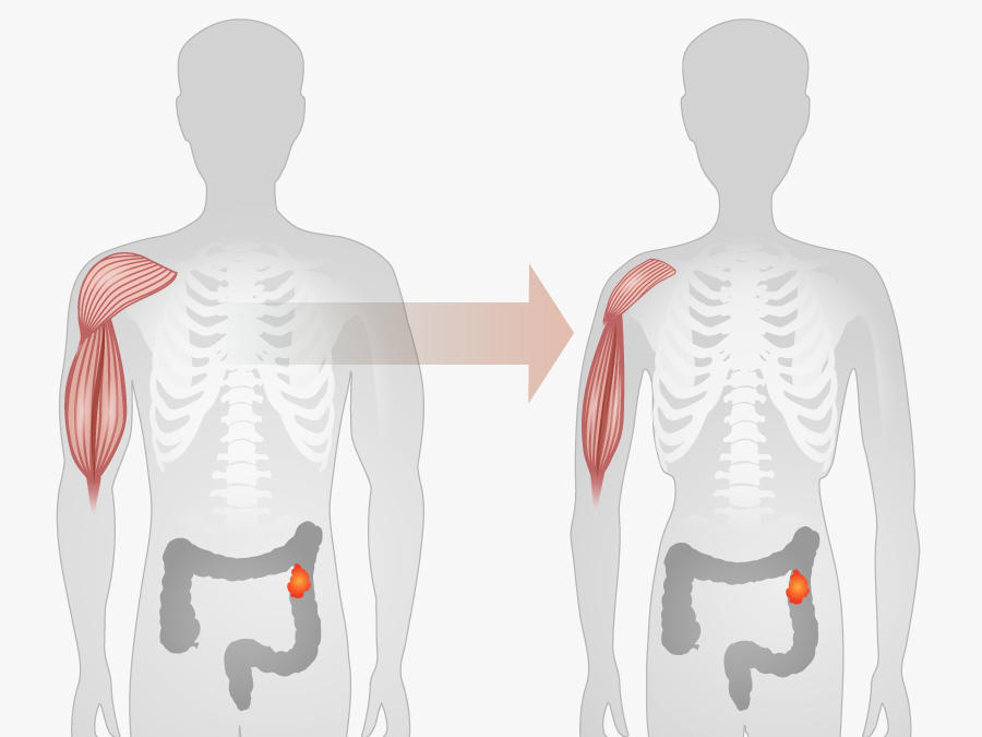 Cartoon outlines of two male bodies before and after cachexia, represented by a thinner body and arm muscle on the right body. 