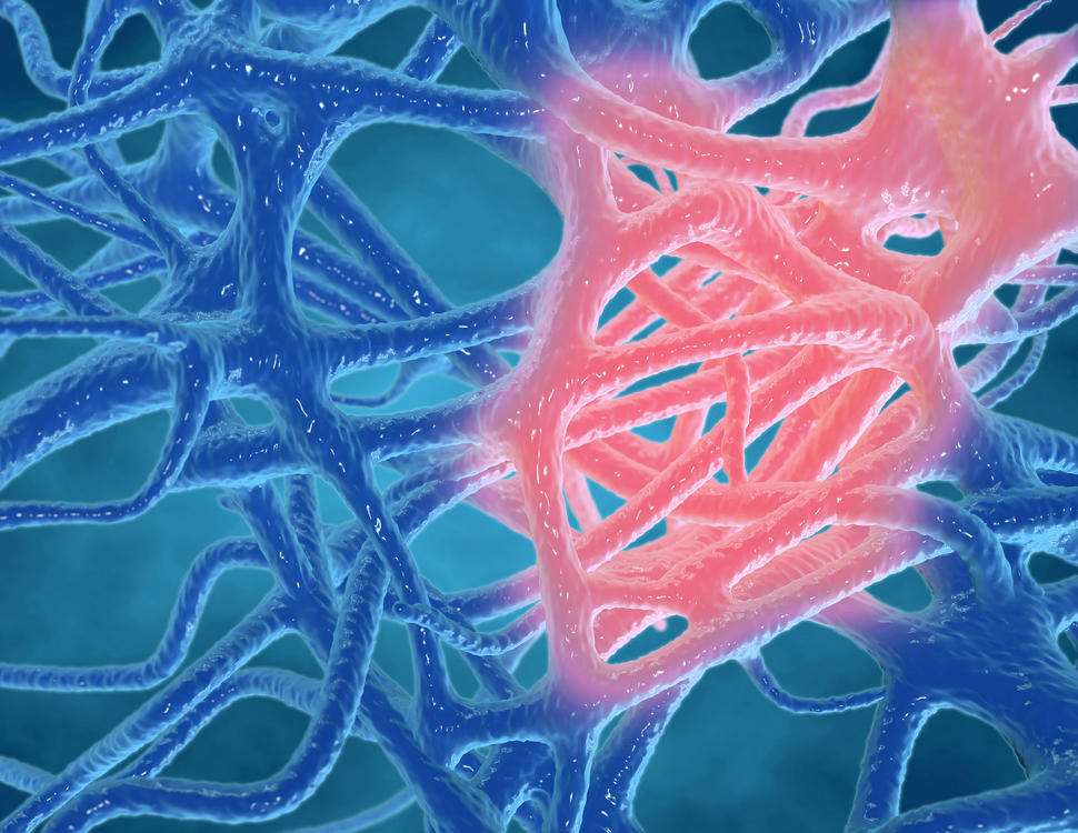 An illustration showing a blue matrix of interwoven, thread-like tissue with a section highlighted in pink to show inflammation.