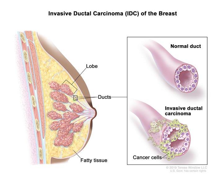 Medical illustration of lobes, ducts, and fatty tissue in a cross section of the breast. An inset shows a normal duct. It also shows a duct with cancer cells that have spread outside the duct which is called invasive ductal carcinoma.
