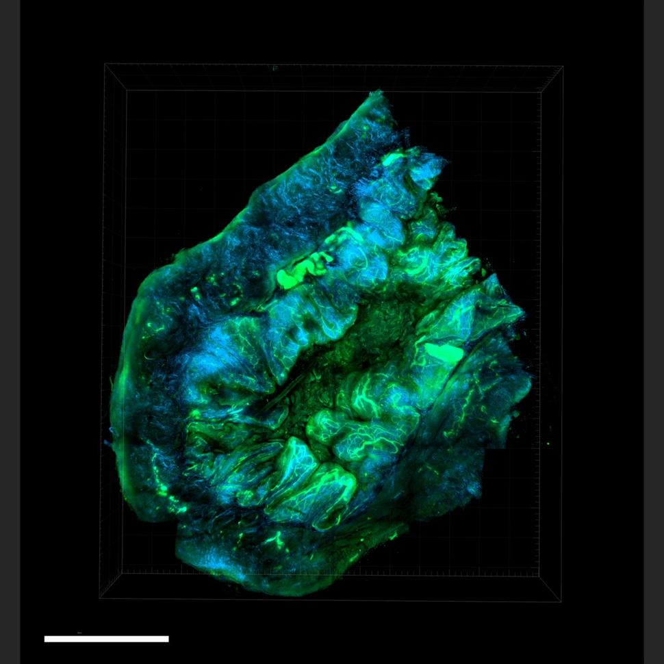 An ovarian tumor grown in a mouse using human cells. Special techniques were used to create the high-resolution, 3-D view of the cancer's cell structure and inner workings.