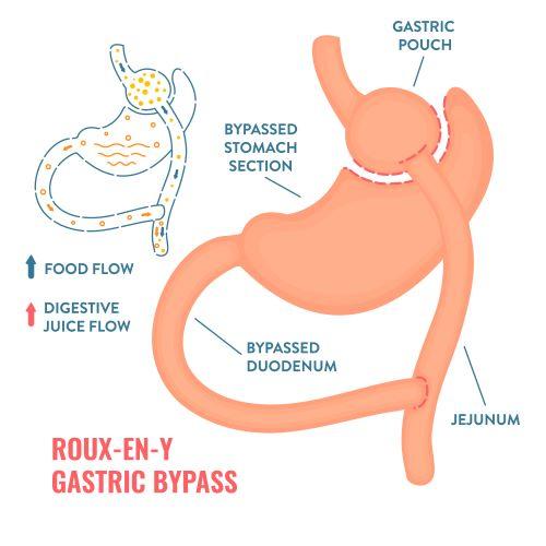 An anatomic illustration of a Roux-en-Y gastric bypass