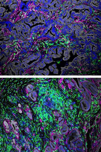 MRTX1133 Targets Tumors with KRAS G12D Mutations - NCI