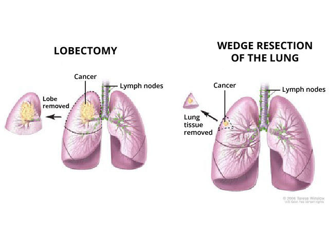 Side by side illustration of a lobectomy and a wedge resection.