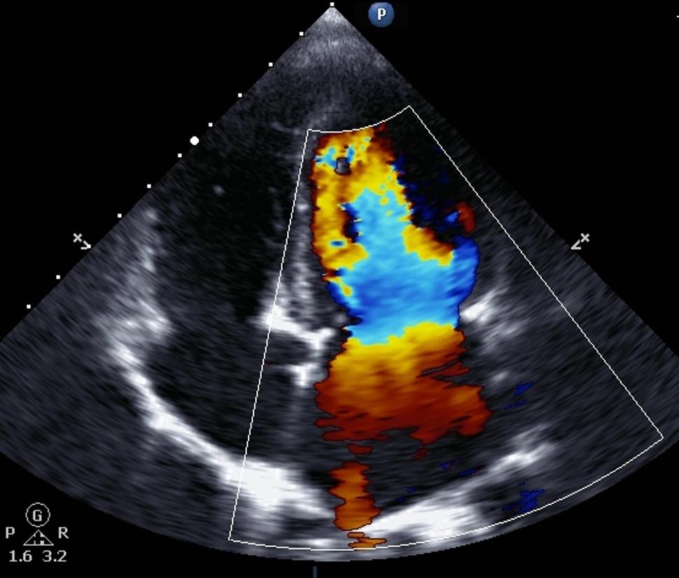 A representative example of a Doppler ECG