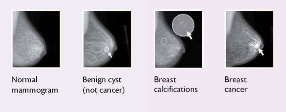 Four mammogram images of breasts show a normal mammogram result, a round benign cyst, tiny white breast calcifications, and breast cancer. 