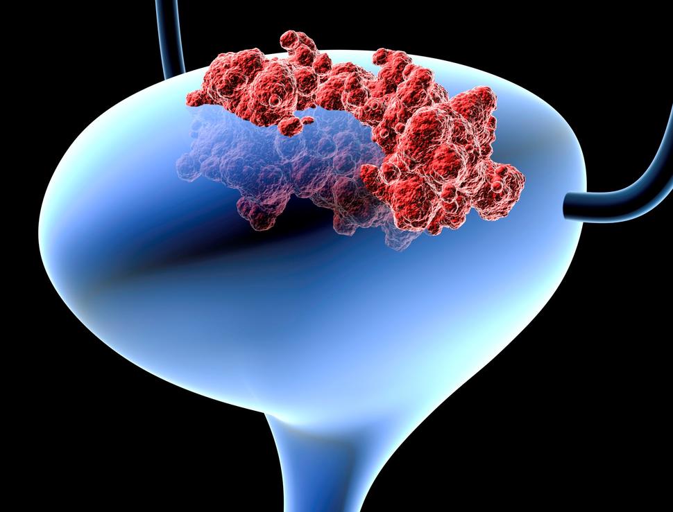 A conceptual image of a bladder in blue and tumors in red.