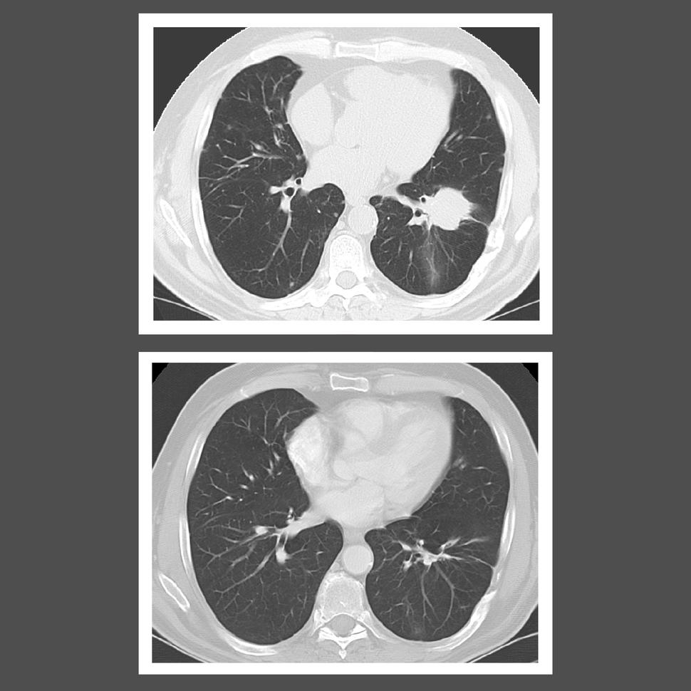 A pair of black and white CT scans. The scan at the top shows a large lesion in a cross-section of the lungs. The scan at the bottom shows the same cross-section of the lungs but with the lesion mostly gone. 