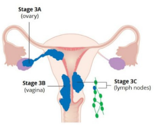 Anatomic illustration of stage 3a, 3b, and 3c endometrial cancer 