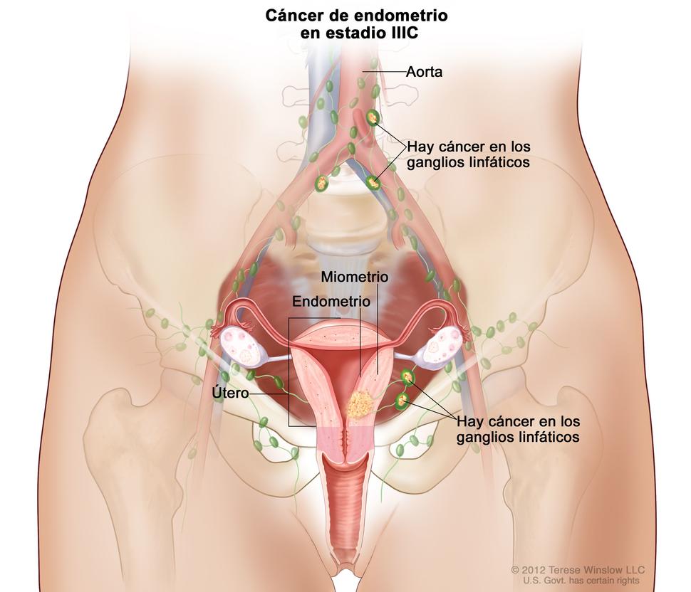El dibujo muestra un cáncer de endometrio en estadio IIIC, en una sección transversal del útero, el cuello uterino, las trompas de Falopio, los ovarios y la vagina.
