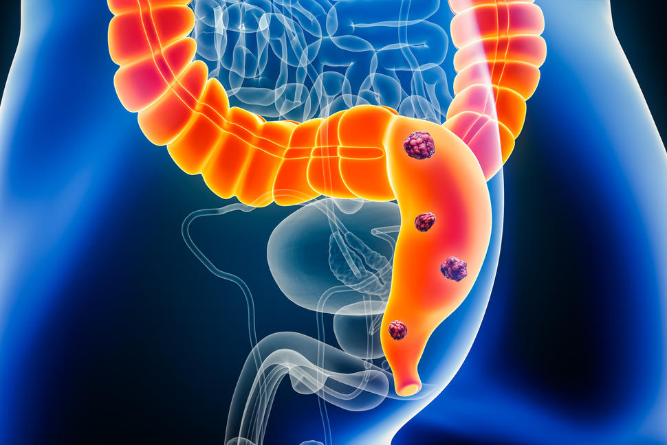 A 3-D illustration of anatomy in the lower abdomen of a male showing tumors in the colon and rectum.