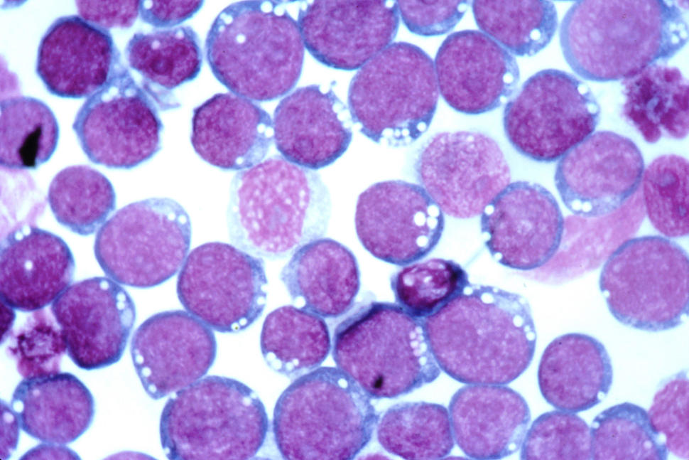 Hematoxylin and eosin (HE) staining of the Epstein-Barr virus (EBV).