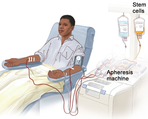 An illustration of a young man undergoing an apheresis procedure for stem cell collection.