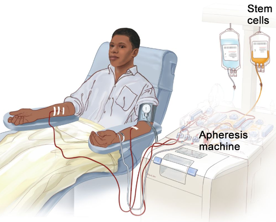 Motixafortide and Stem Cell Transplants for Multiple Myeloma - NCI