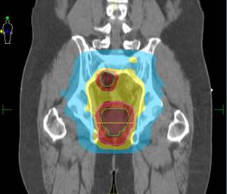 Plan de dosificación de radioterapia de intensidad modulada para un adulto con cáncer de recto.