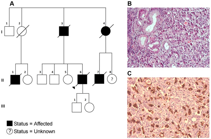 A three-part image. Part A shows a family pedigree. Parts B and C are pathology images of gastric cancer.