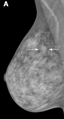 A mammogram with arrows indicating an asymmetry in the upper area of the breast.