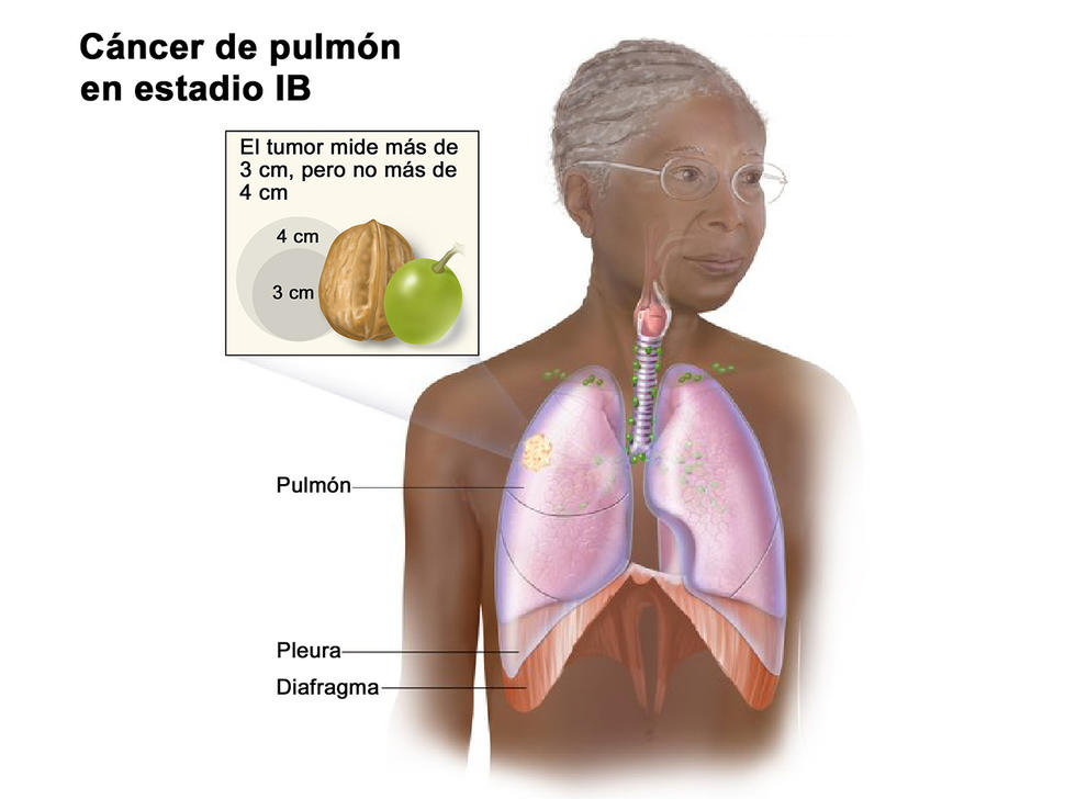 Ilustración del cáncer de pulmón en estadio 1B.