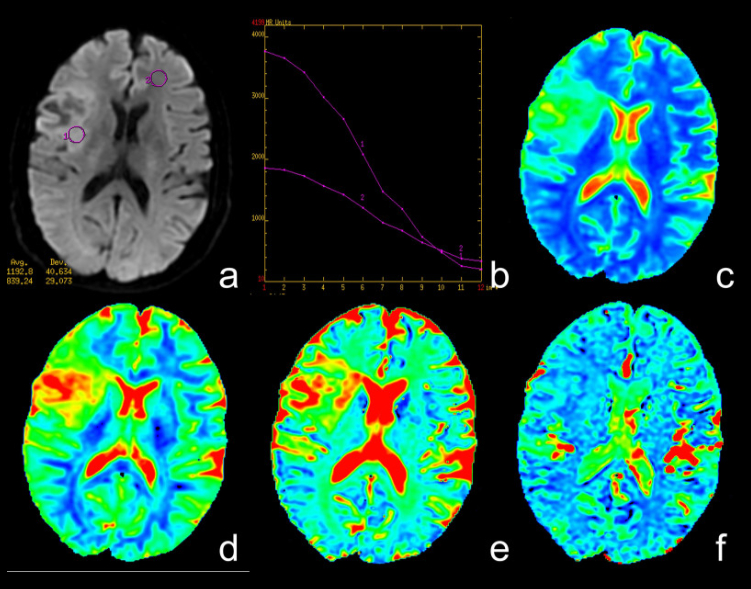 MRI images of a low-grade glioma