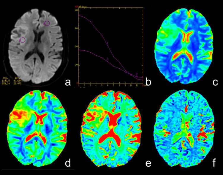 Imágenes de resonancia magnética de un glioma de grado bajo