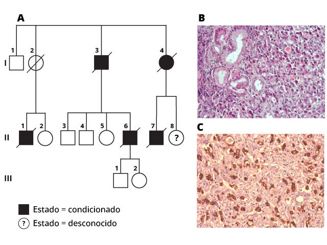 Imagen con tres partes: la parte A muestra la genealogía familiar, las partes B y C son imágenes de tejido celular con cáncer gástrico.