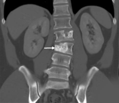 A CT scan showing a metastatic tumor embedded in a spinal vertabrae