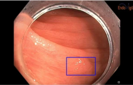 An image of a polyp identified by CAD during a colonoscopy