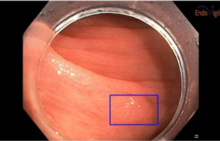 Imagen de un pólipo identificado con asistencia por computadora durante una colonoscopia.