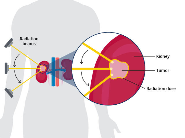 An illustration showing multiple radiation beams targeting a tumor in a kidney.