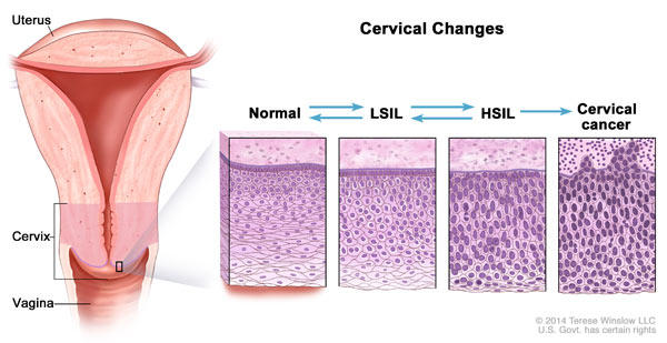 Cervical changes; drawing shows a cross-section of the uterus, cervix, and vagina. Also shown are four panels showing cell changes inside the cervix. The first panel shows normal cells. The second and third panels show abnormal cells called LSIL and HSIL. The fourth panel shows cervical cancer cells. Arrows are used between the panels to show that normal cells may become LSIL or HSIL, which may or may not become cancer.