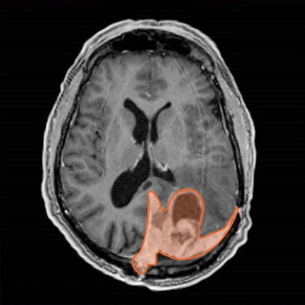 An imaging scan of a brain with a meningioma highlighted in orange.