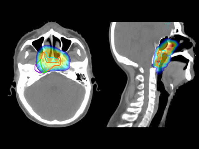 Imágenes diagnósticas de un carcinoma de nasofaringe con dosis de radiación presentadas en diferentes colores.