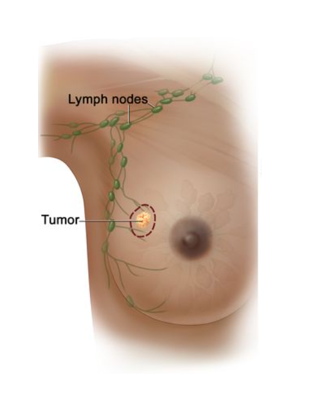 An illustration of a small tumor in a breast and nearby lymph nodes in the armpit.