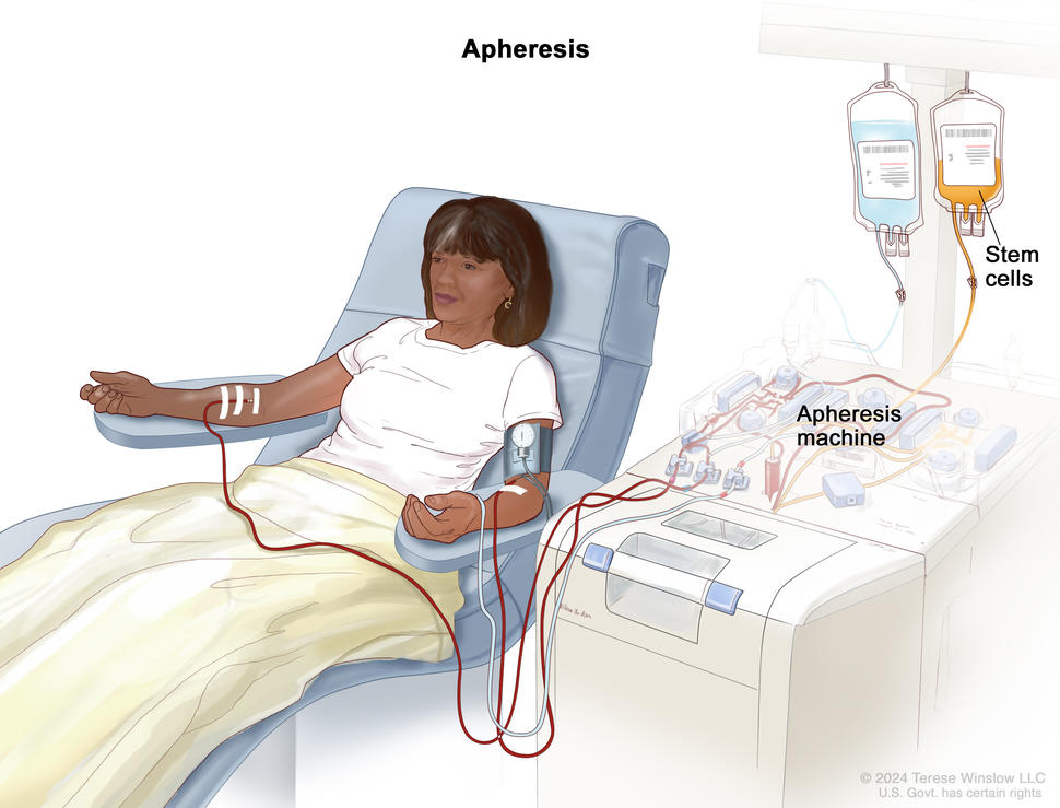 Woman sits in chair attached to an apheresis machine. The needle in one arm removes blood where it flows into the apheresis machine. Then, another needle carries blood from the apheresis machine into her other arm.