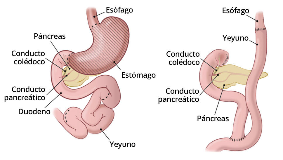 Dos ilustraciones médicas que muestran el sistema gastrointestinal antes y después de extirpar del estómago. A la izquierda, la ilustración muestra la anatomía gastrointestinal normal con líneas de puntos donde se hacen los cortes durante la gastrectomía total; la ilustración de la derecha muestra la anatomía gastrointestinal sin el estómago.