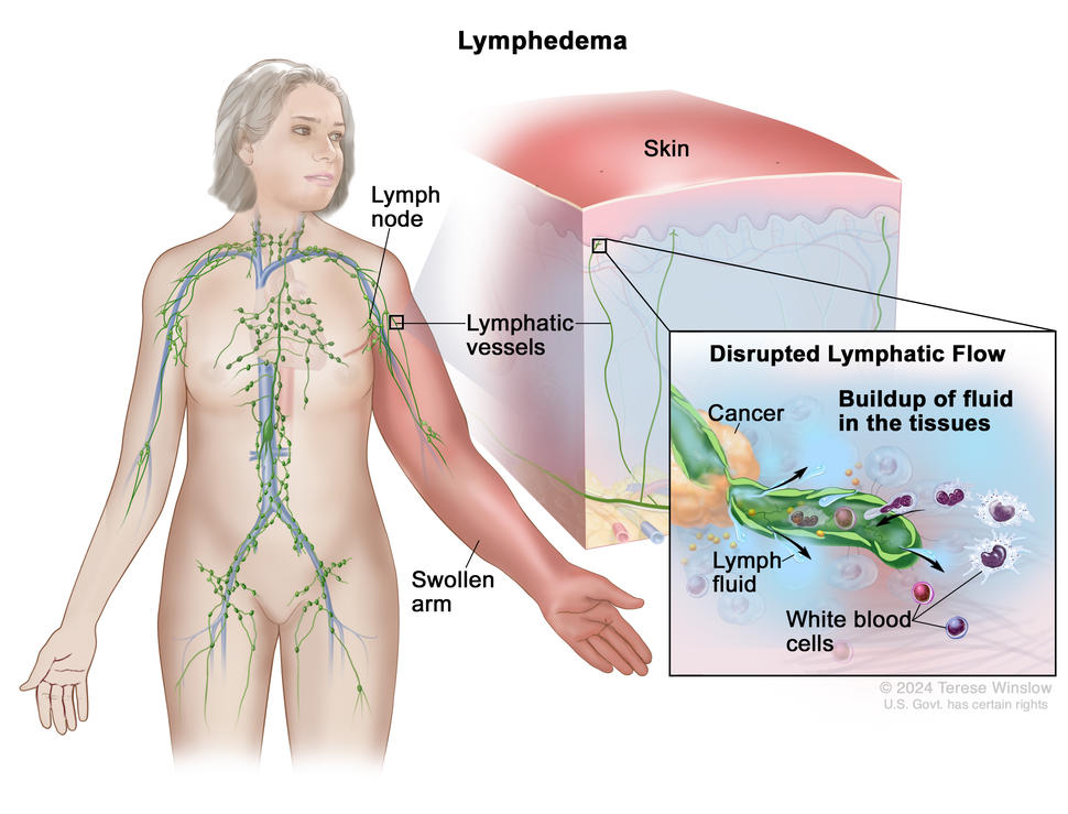 Lymphedema; drawing showing a female figure with a red, swollen arm. The lymph nodes and lymphatic vessels are also shown in the figure. There is a pull-out from the swollen arm showing a top layer of red, hardened skin. There is also a pull-out box from a lymphatic vessel below the skin that shows a cancerous tumor blocking the flow of lymph fluid through a lymphatic vessel and a buildup of fluid and white blood cells in the surrounding tissues.