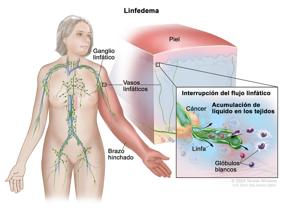 Linfedema. En el dibujo se observa una mujer con un brazo rojo e hinchado. También se señalan ganglios y vasos linfáticos en su cuerpo. Hay una ampliación del brazo hinchado en el que se observa la capa superior de la piel endurecida y roja. Además, en un recuadro se ve un vaso linfático debajo de la piel y un tumor canceroso que interrumpe el flujo de la linfa, así como una acumulación de líquido y glóbulos blancos en los tejidos que rodean el vaso.