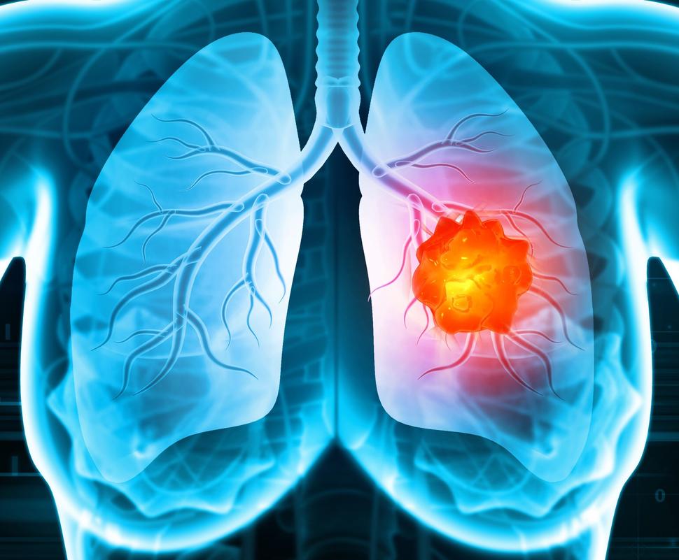A stylized chest x-ray illustration showing a bright orange tumor in the right lung.