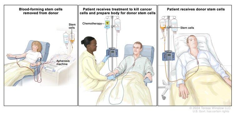 3 panels showing the stem cell transplant process 