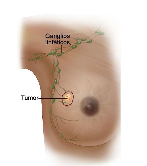 Imagen de una mama (seno) que muestra un tumor y la ubicación de los ganglios linfáticos cercanos.