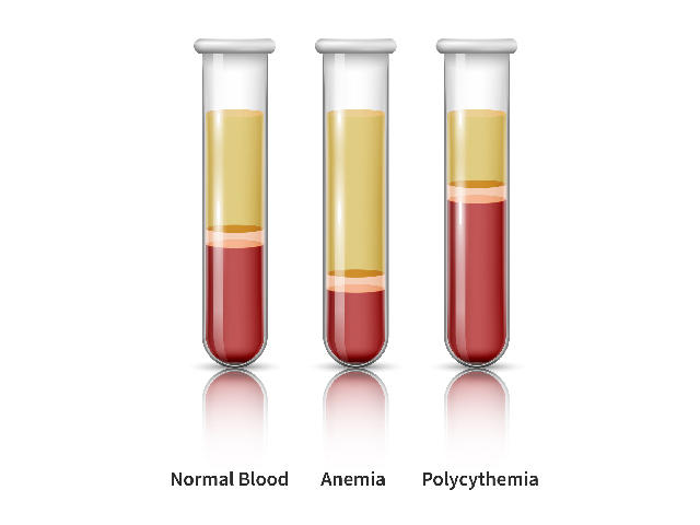 Illustration of three test tubes filled with blood separated into layers of plasma, buffy coat, and red blood cells. The three tubes show the components of normal blood, anemia, and polycythemia.