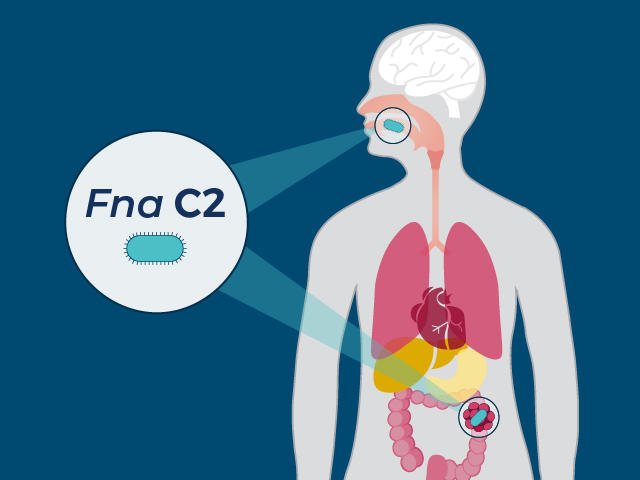 A silhouette of a human body showing Fna C2 bacterium in the mouth and a colon tumor.