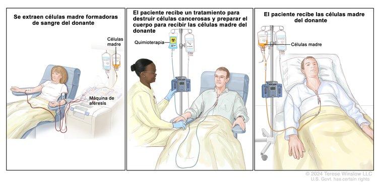 Se observa una ilustración con tres paneles. Panel 1: el paciente está conectado a una máquina de aféresis. Panel 2: el paciente recibe tratamiento de cáncer. Panel 3: el paciente recibe sus propias células madre.
