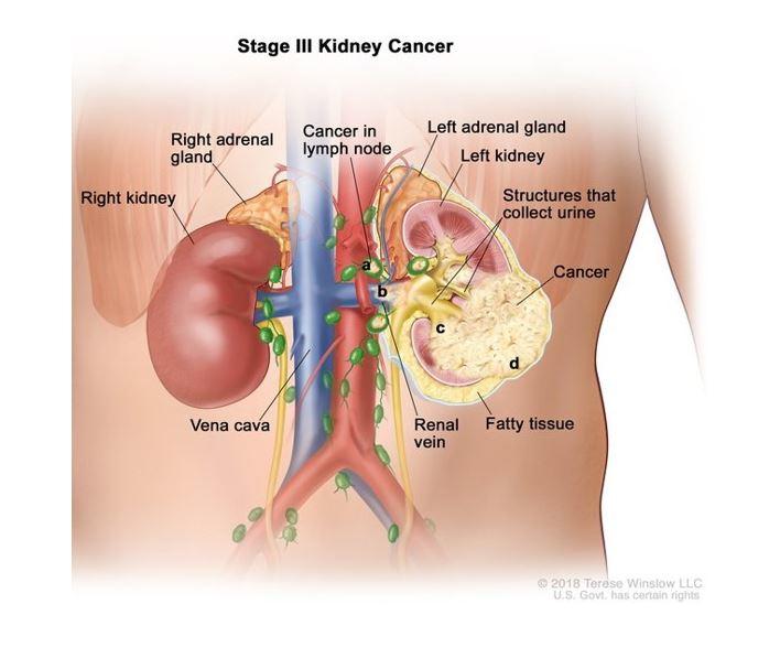 An anatomic illustration of stage 3 kidney cancer