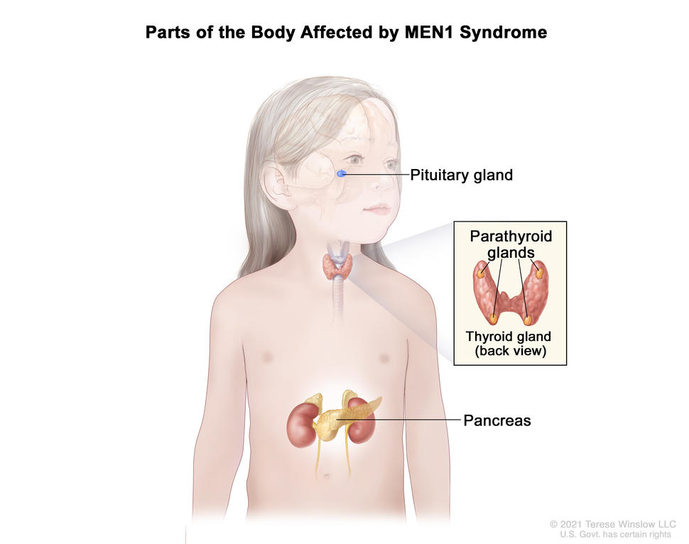 Drawing shows parts of the body affected by MEN1 syndrome, including the pituitary gland, parathyroid glands, and pancreas. There is also an inset that shows the back view of the thyroid gland with the four pea-sized parathyroid glands.